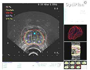 Imaging prostate cancer with magnetic resonance spectroscopy (MRS)